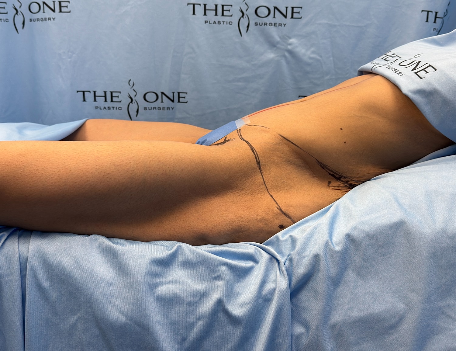 Patient preparing for plastic surgery procedure.