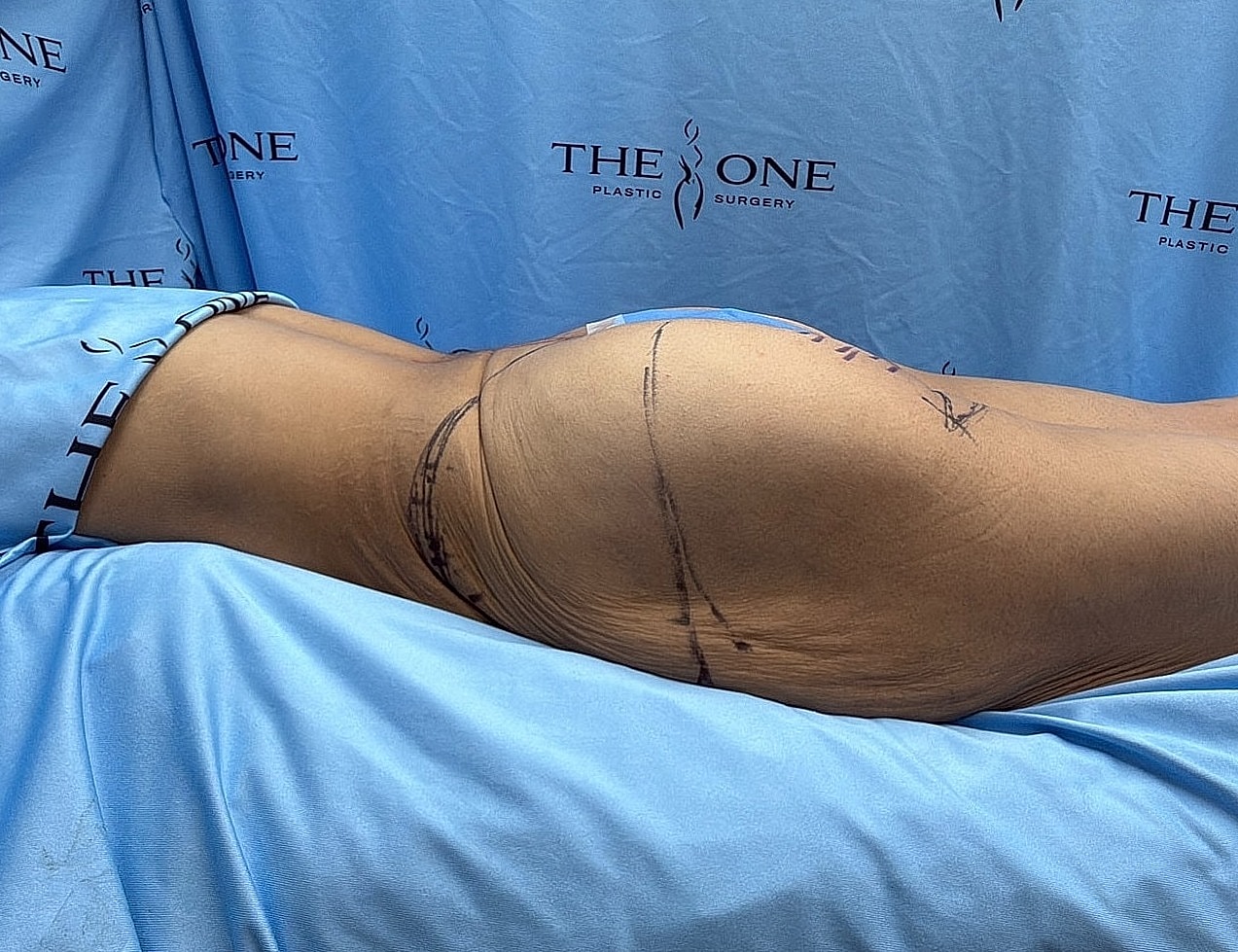 Surgical markings on patient for plastic surgery procedure.
