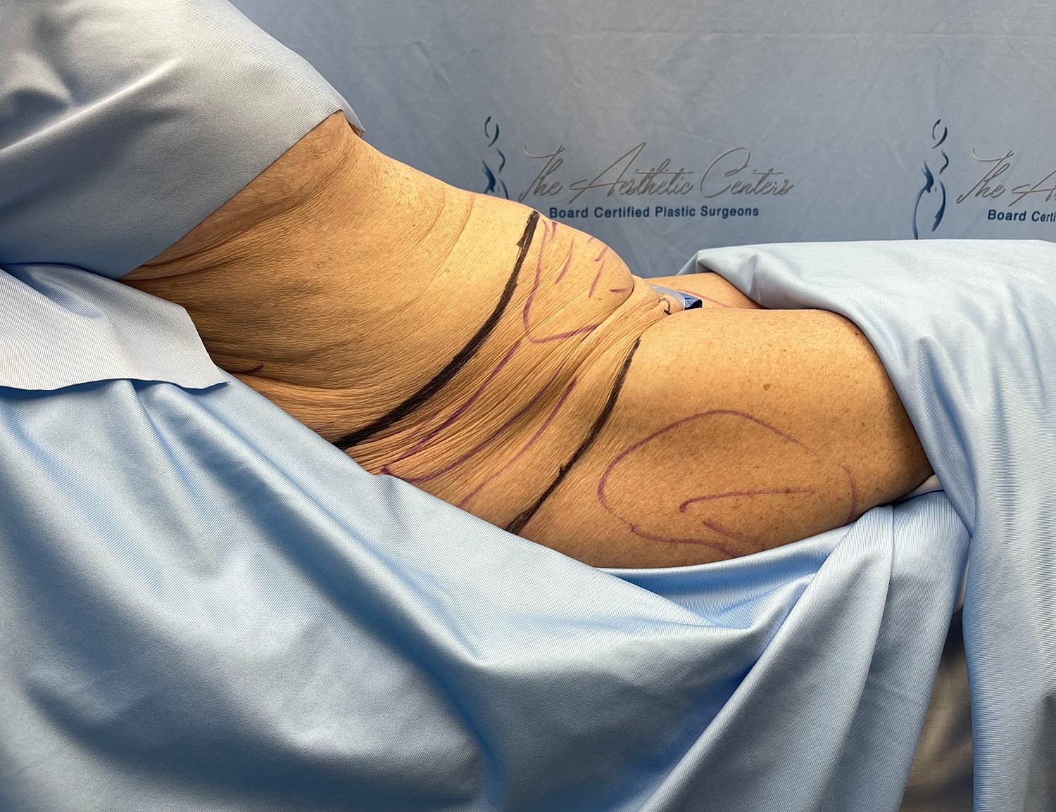 Body contouring markings on patient’s abdomen.