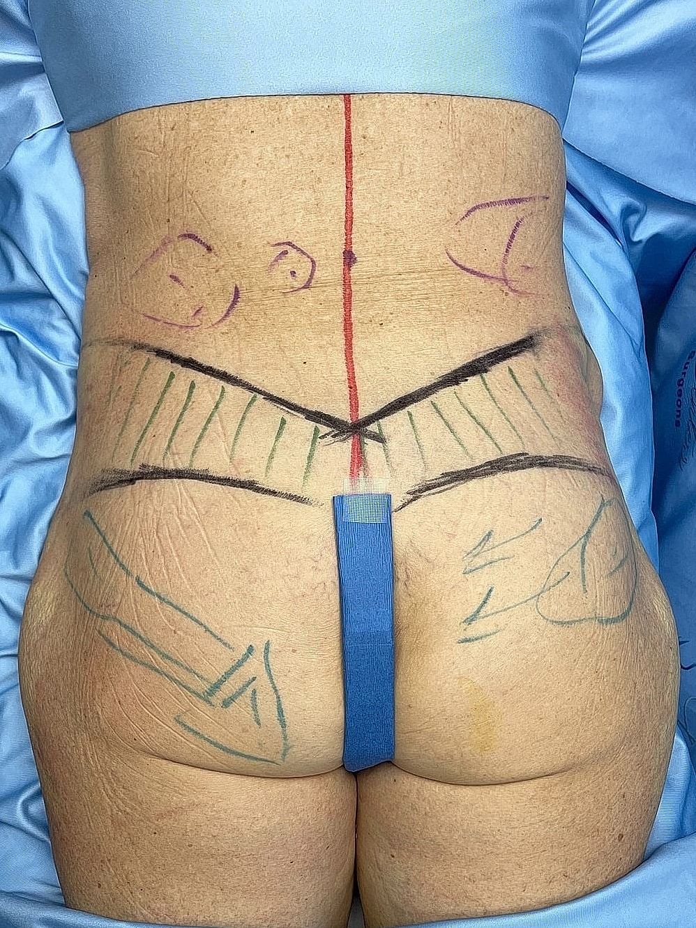 Surgical markings on lower back for procedure.