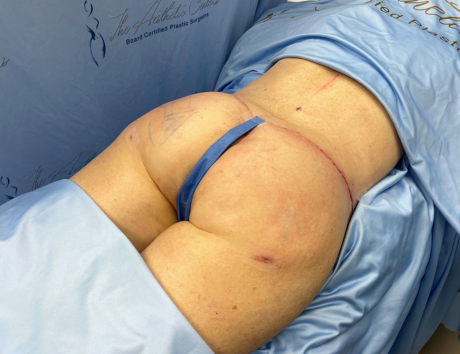 Post-surgery view of patient’s back area.