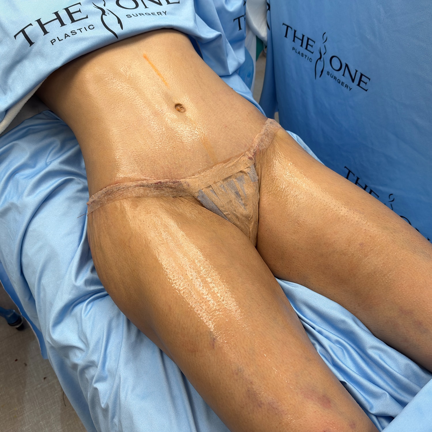 Patient preparation for a surgical procedure.