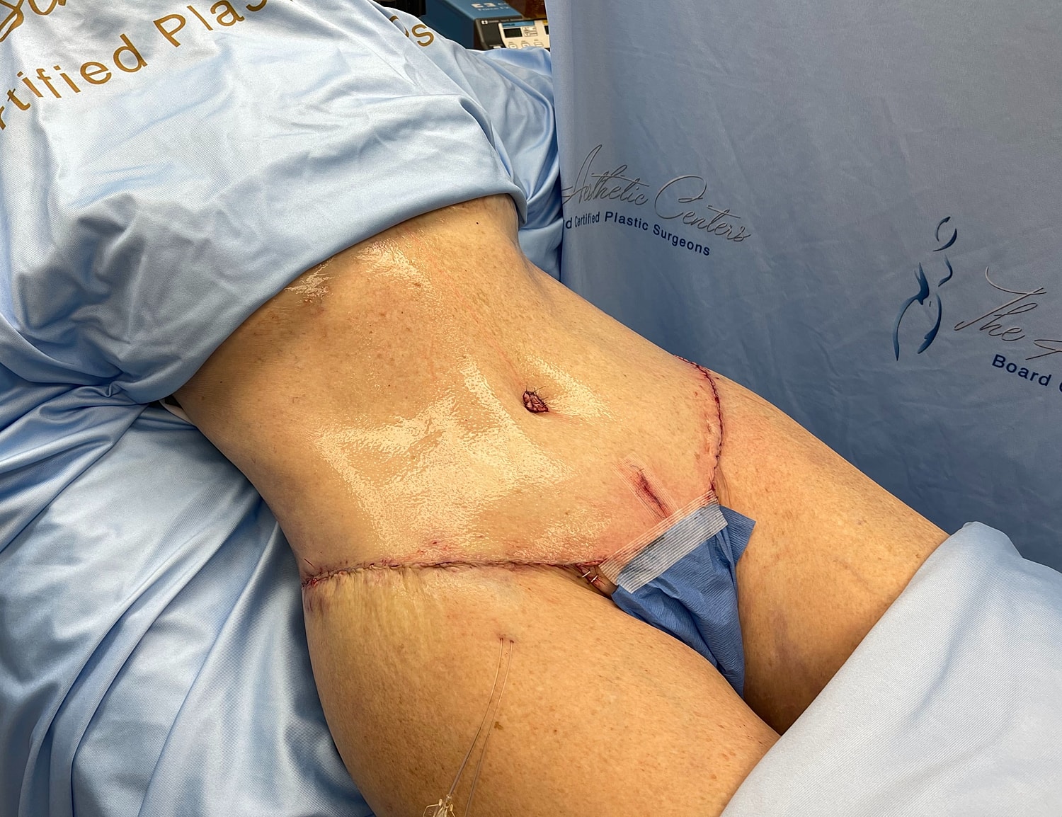 Surgical incision on patient’s abdomen post-operation.