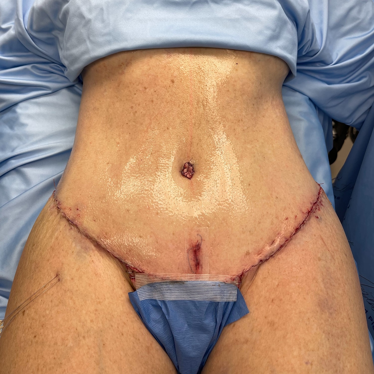 Post-surgical abdomen with stitches and dressing.