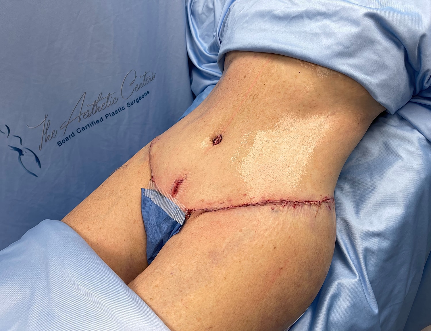 Post-surgery abdomen with healing incision.
