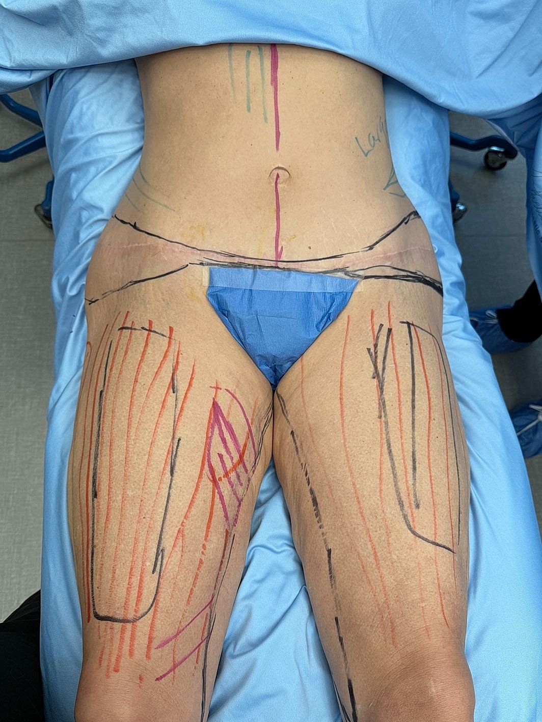 Marked legs preparing for a medical procedure.