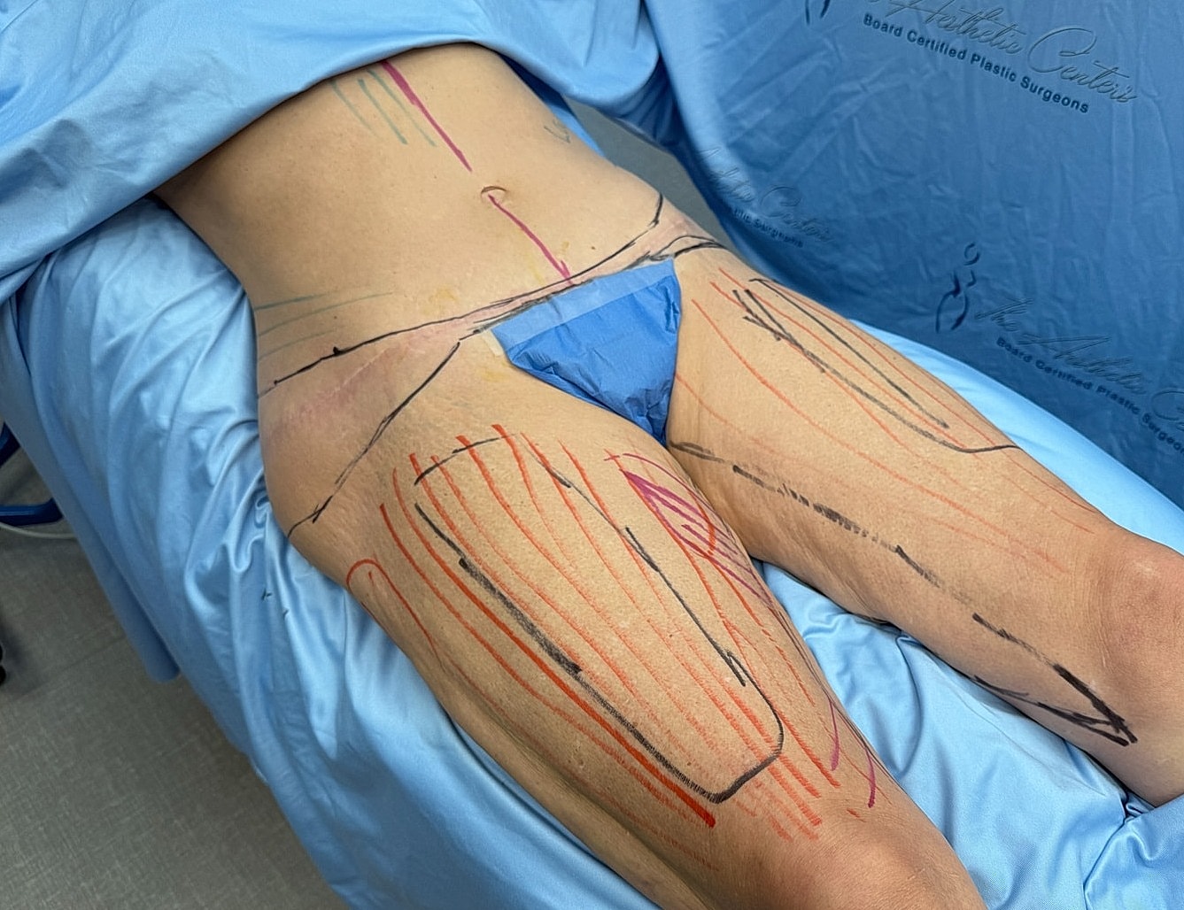 Marked thigh in preparation for surgery.