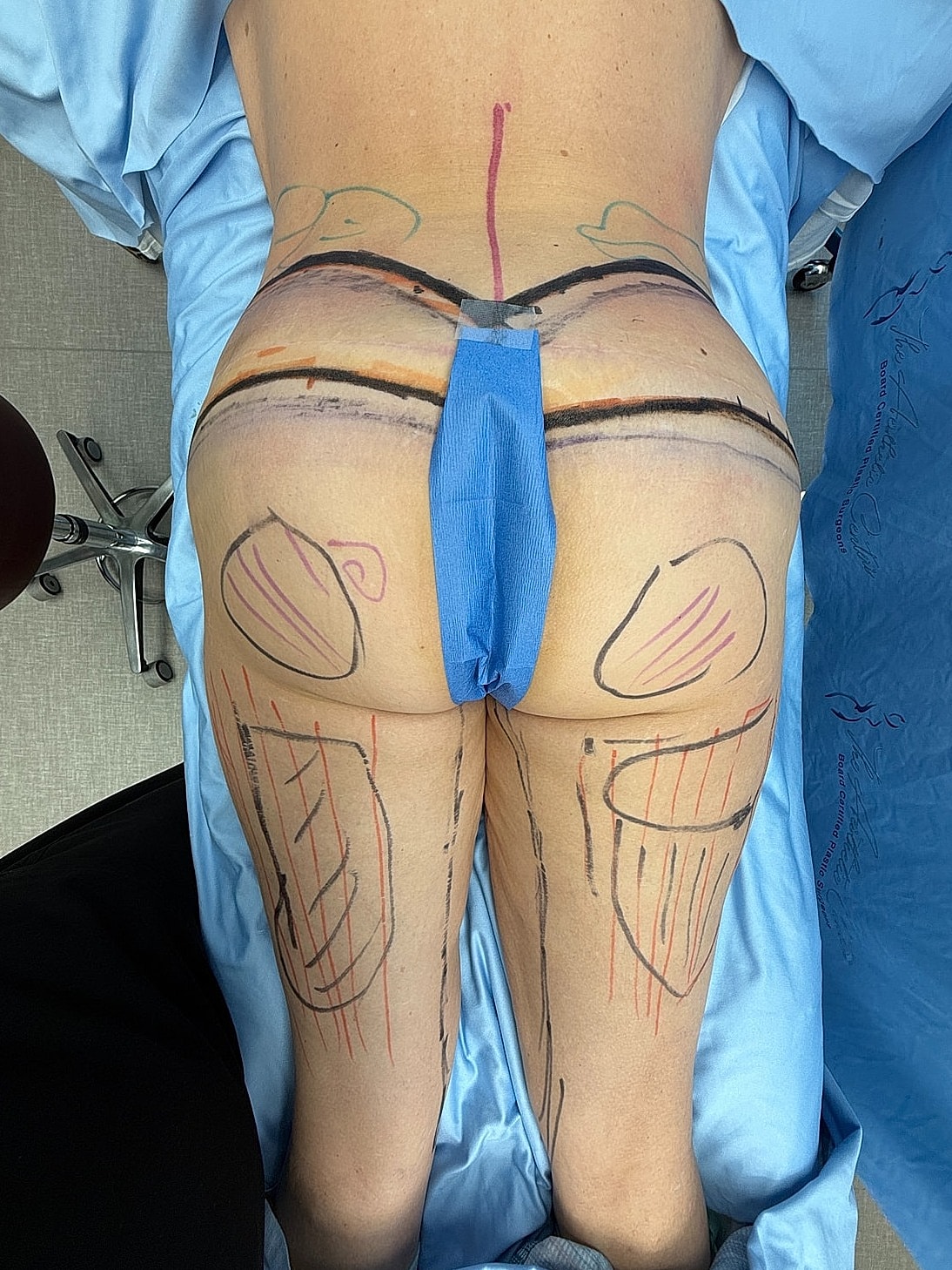 Body markings for a cosmetic procedure demonstration.