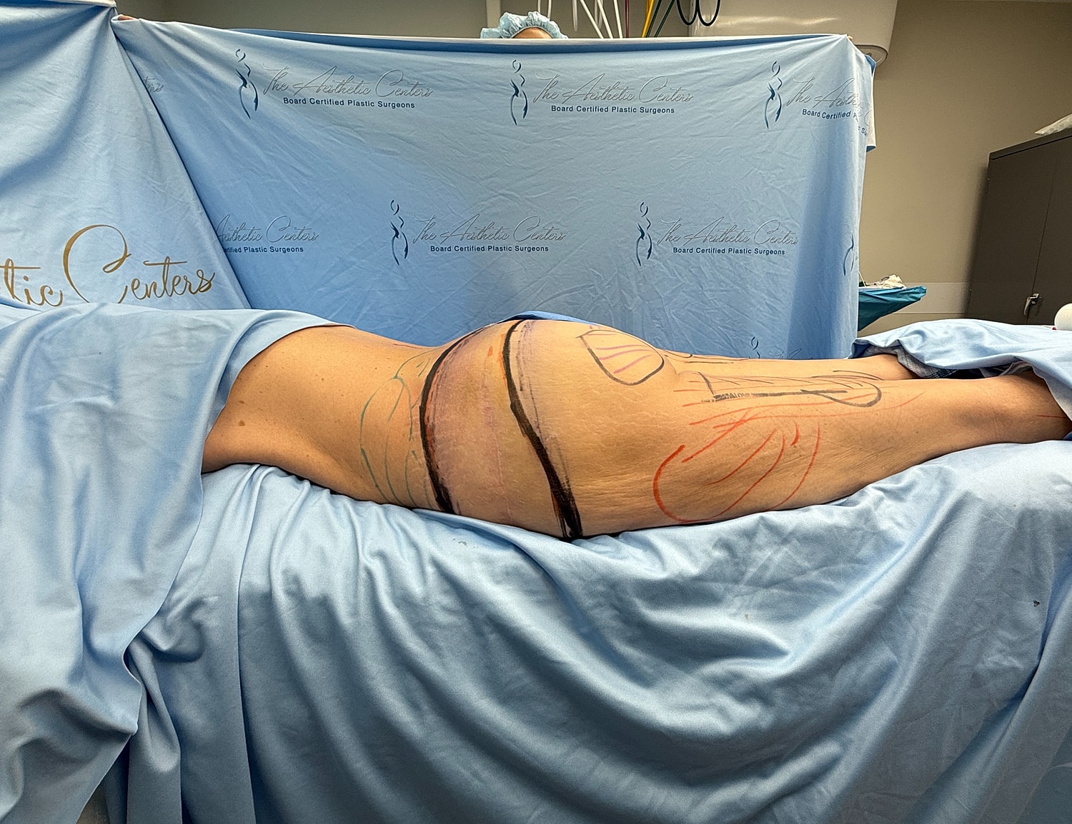 Patient in surgical setting, markings on body.