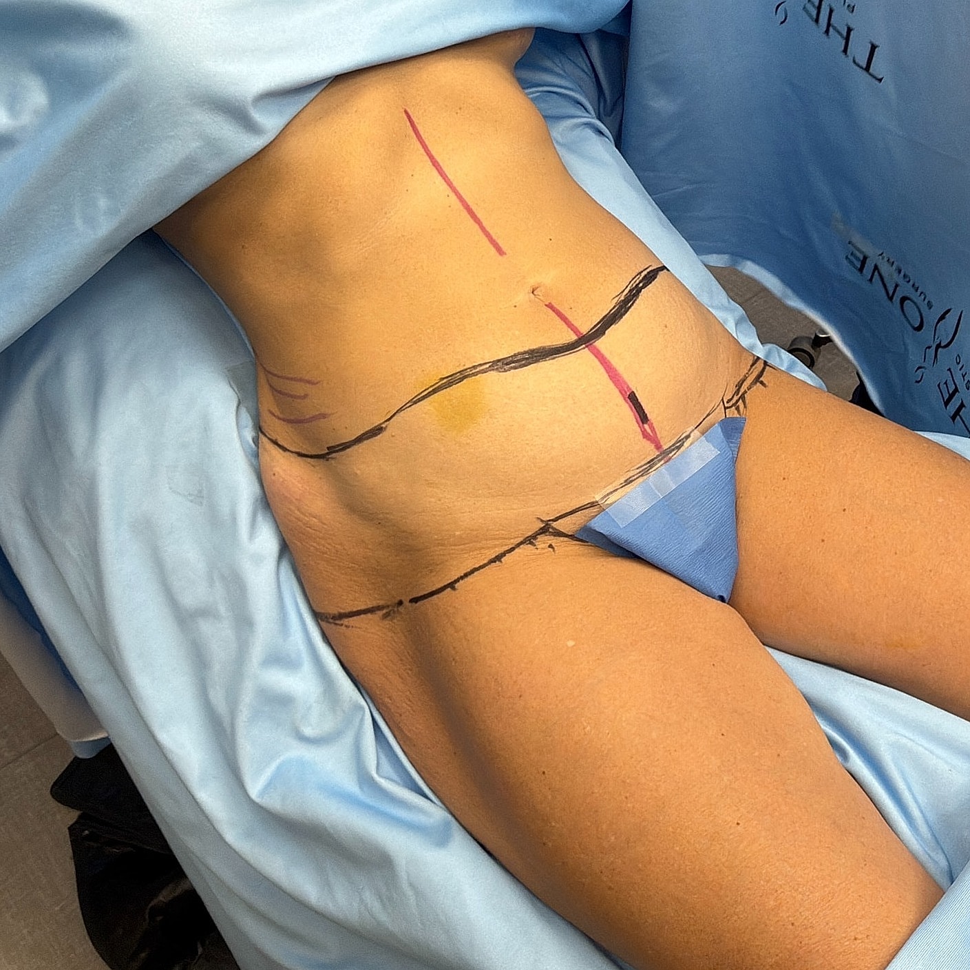 Surgical markings on abdomen for procedure preparation.