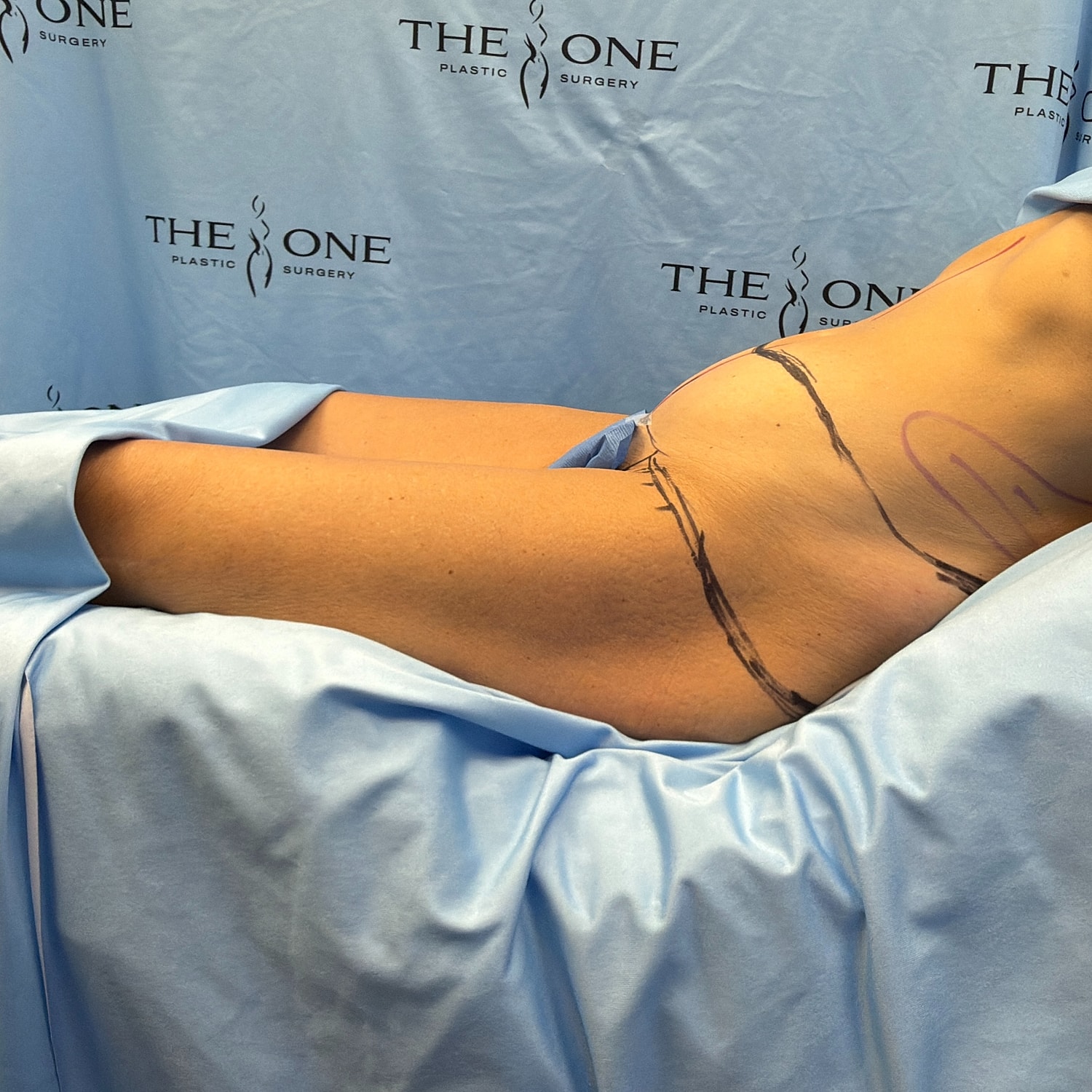 Patient in surgical prep with markings on skin.