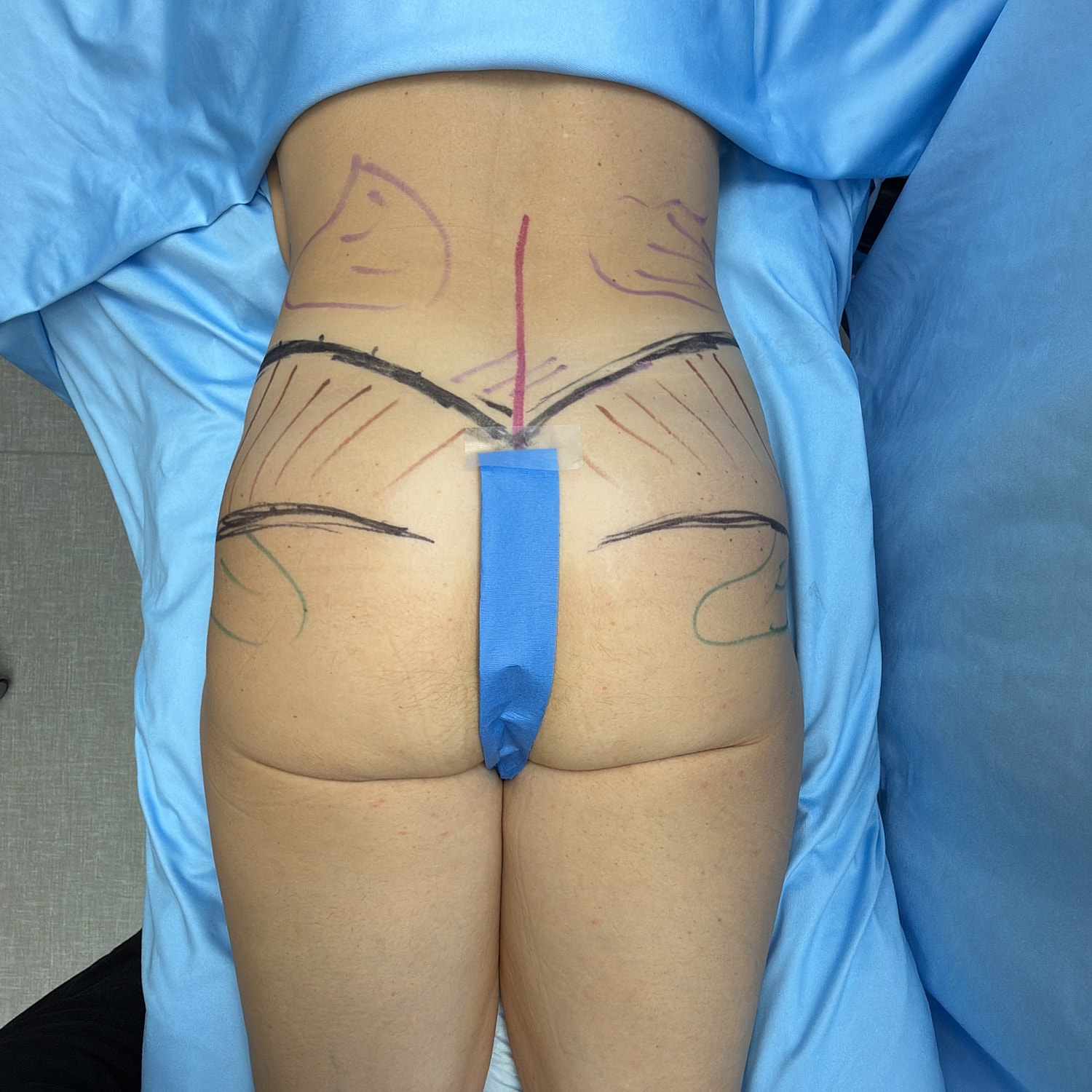 Body markings for surgical procedure preparation.