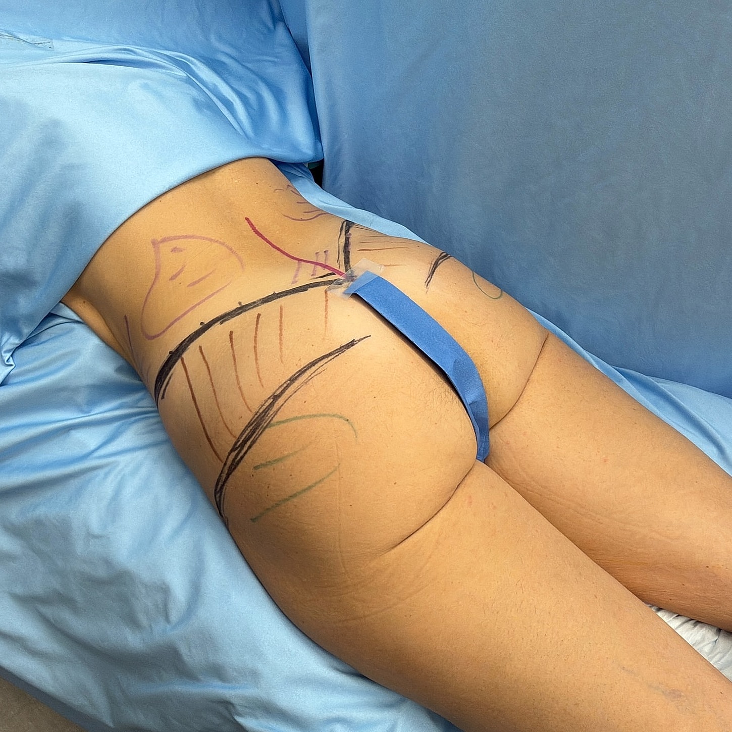 Pre-operative marking on patient's lower back.