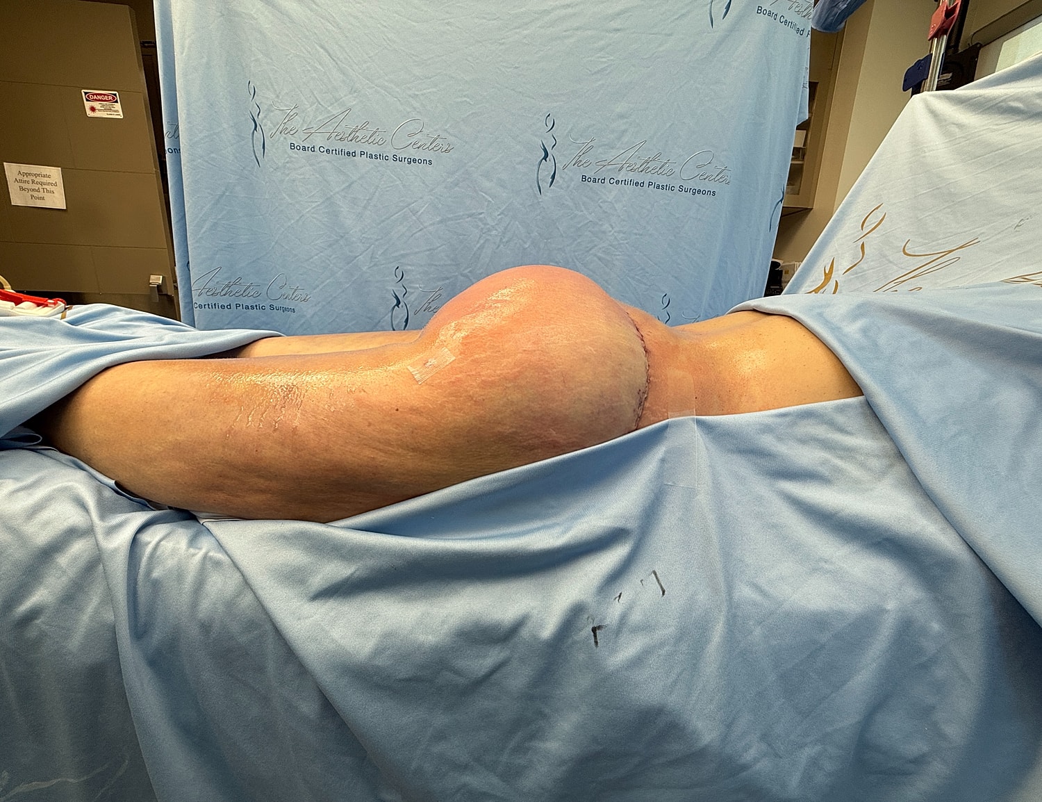 Surgical view of body contouring procedure.