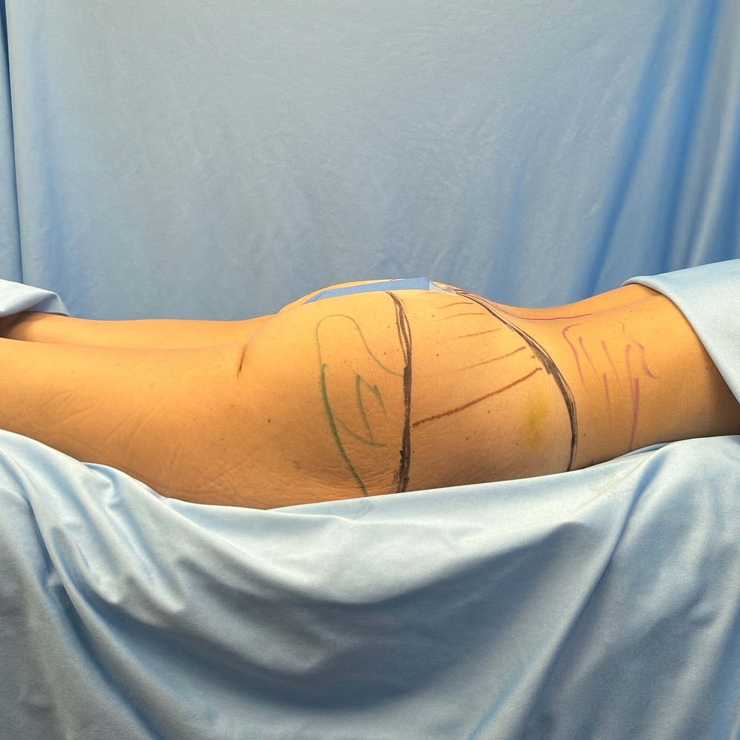 Body contouring markings on a patient's thigh.