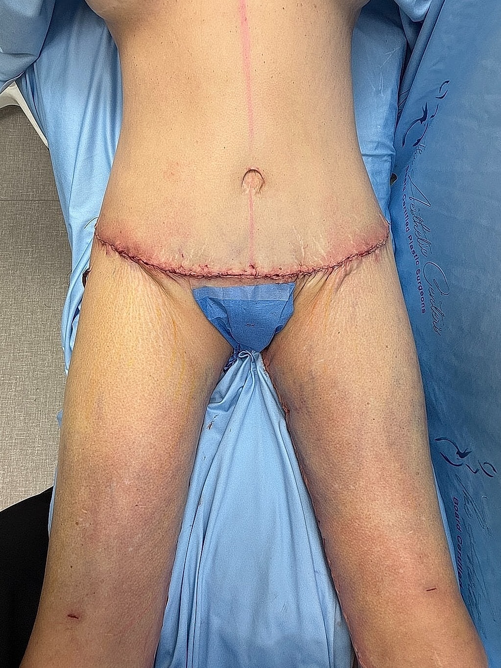 Post-surgery abdominal and thigh area with sutures.
