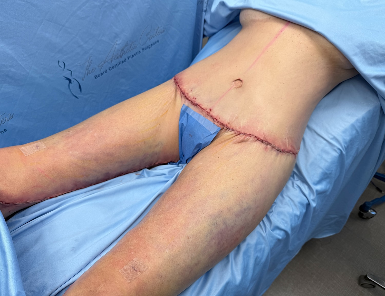 Surgical site after body contouring procedure