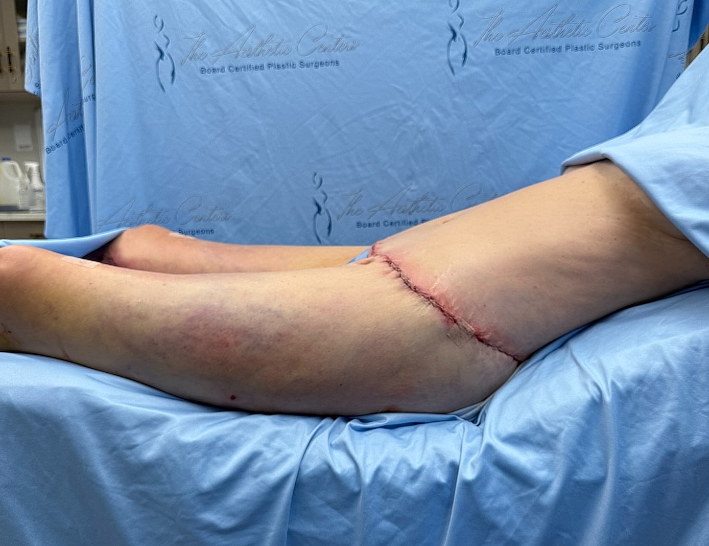 Surgical incision on a patient's thigh area.
