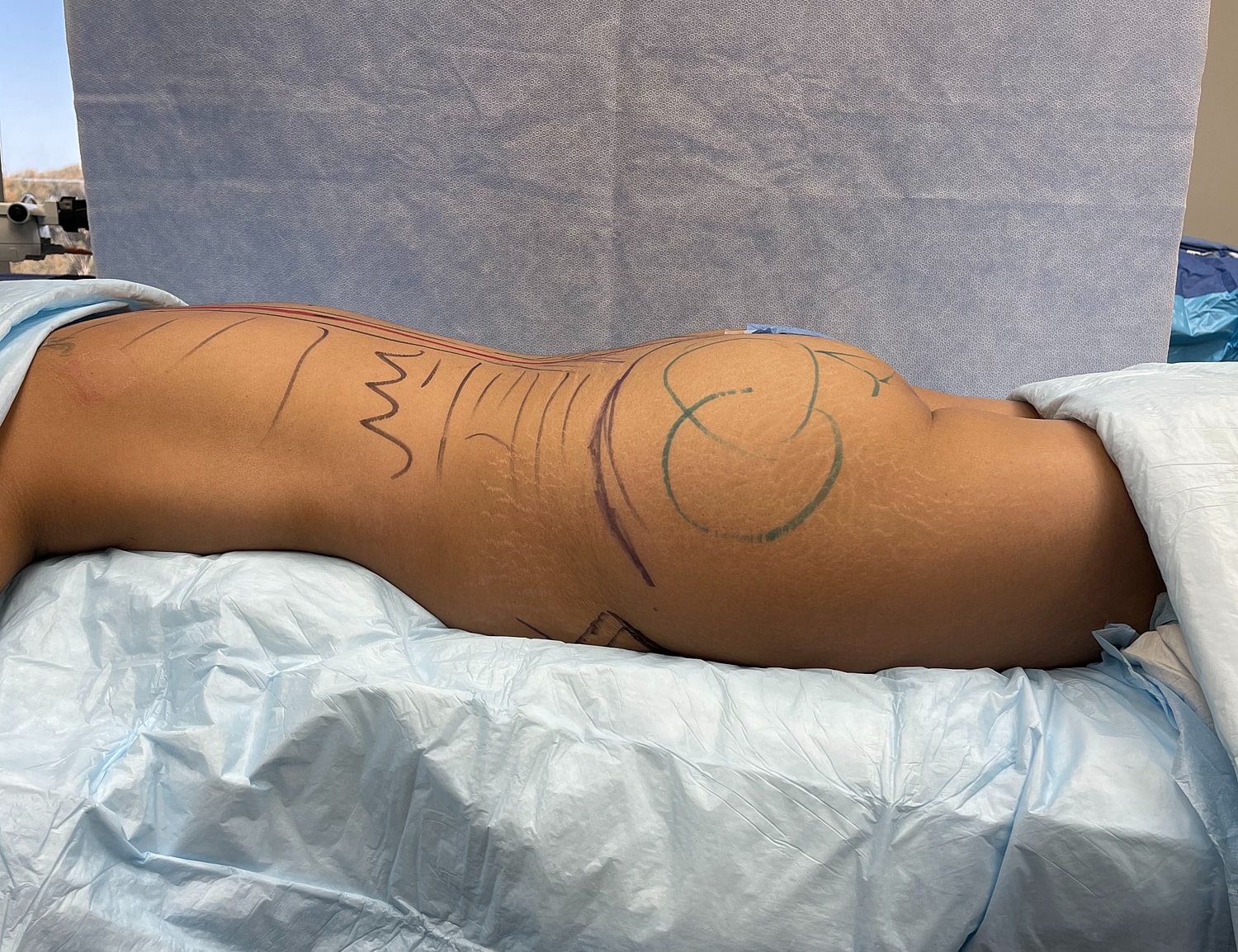 Body contouring markings on patient’s side.