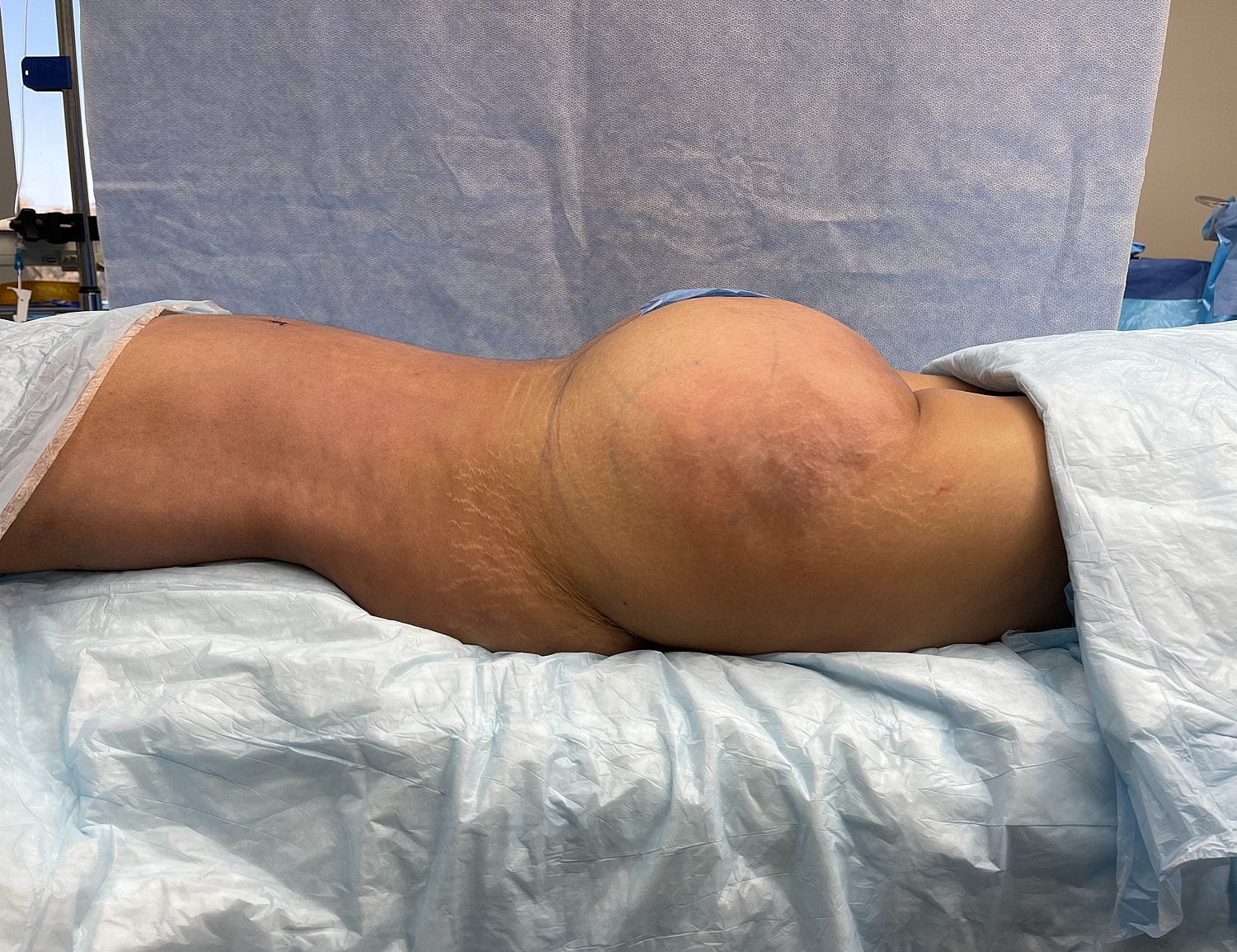 Patient lying on operating table with surgical drape.