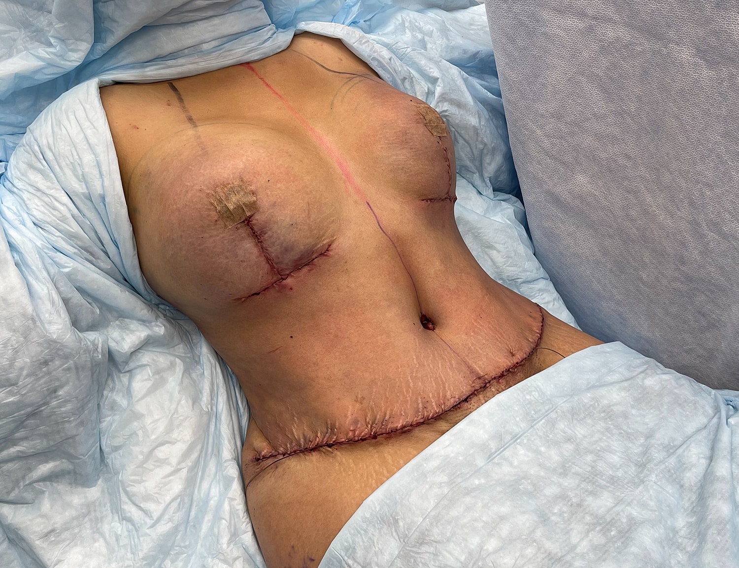 Post-surgery torso showing stitches and healing.