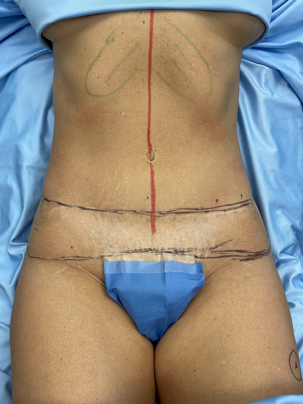 Patient's abdomen with surgical markings and drapes.