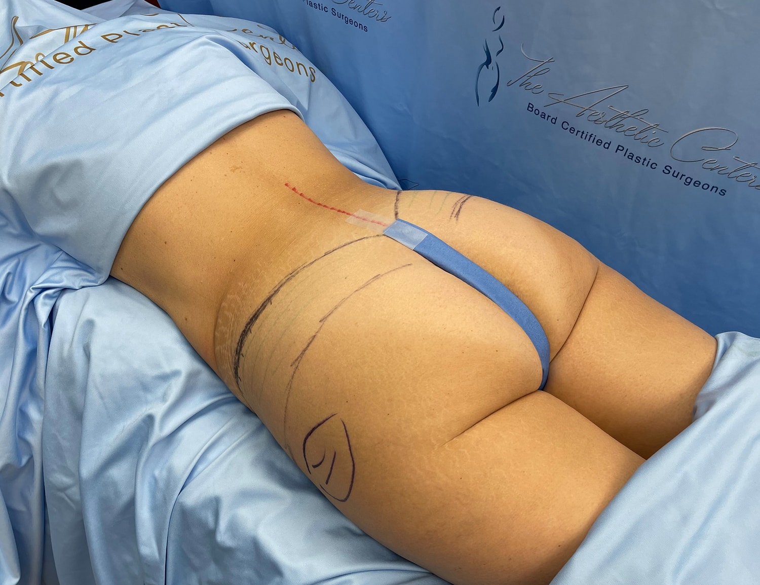 Patient preparing for plastic surgery procedure.