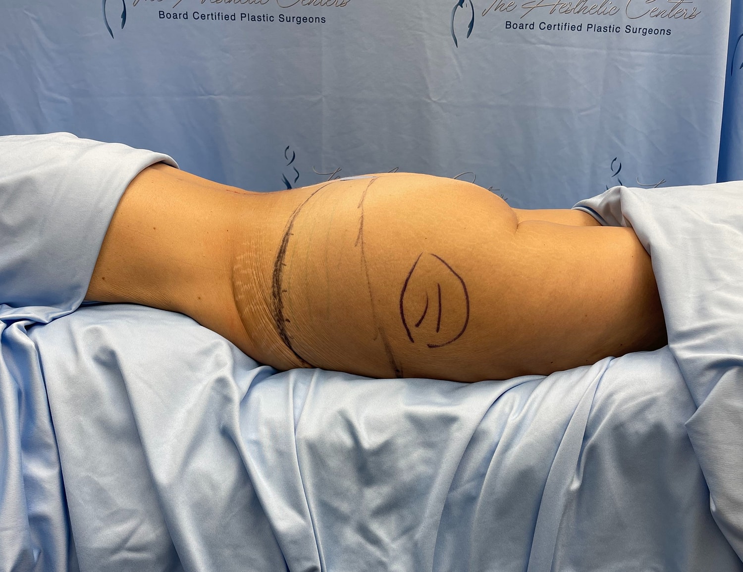 Surgical markings on a patient’s side view.