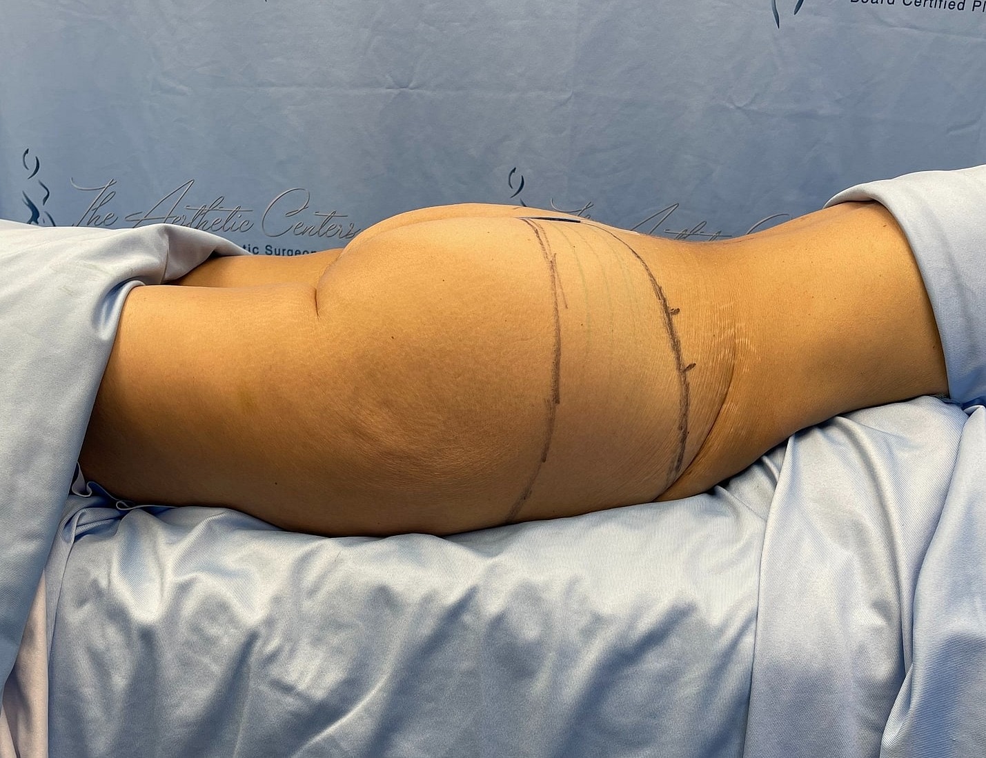 Patient preparation for cosmetic surgery procedure.