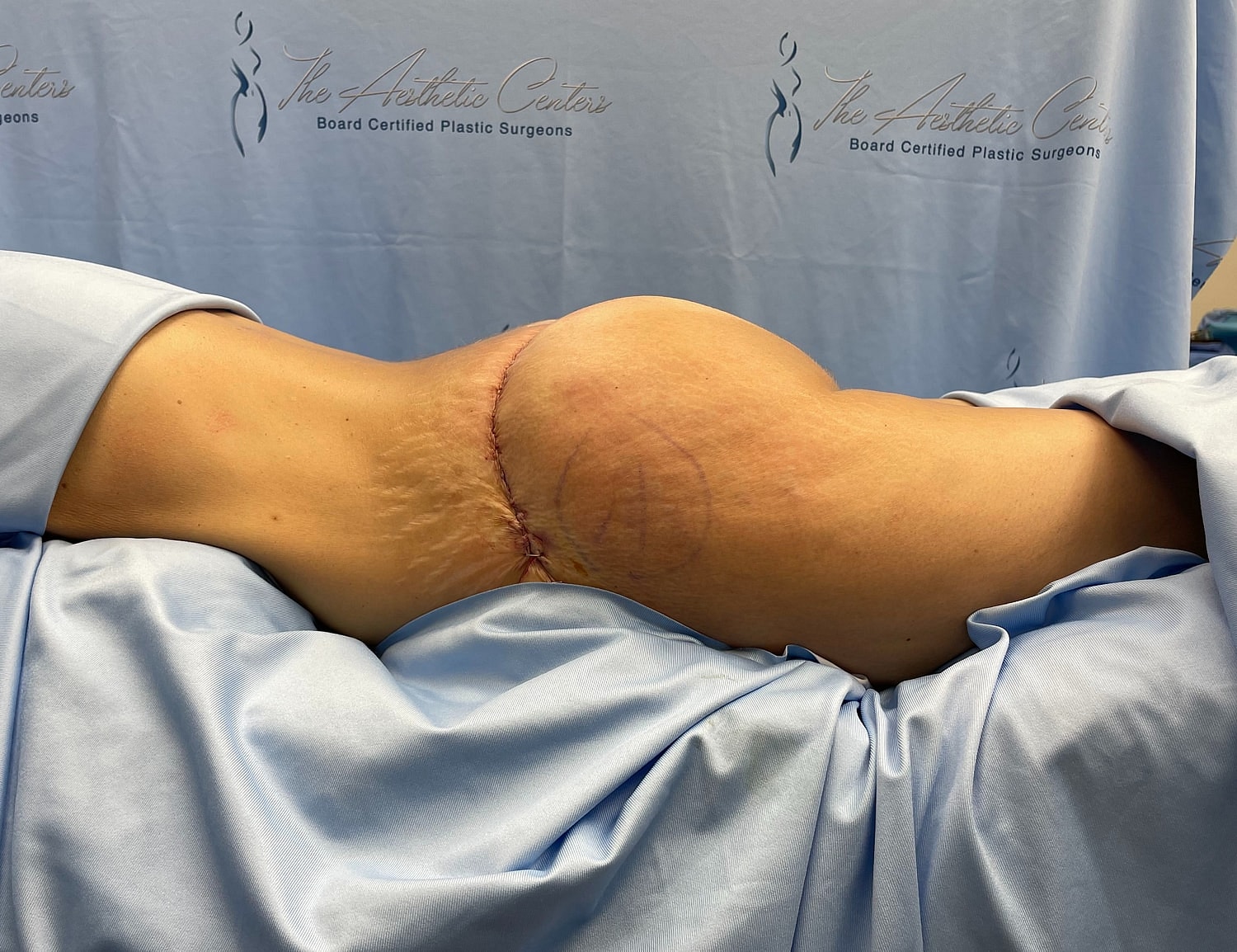 Post-surgery view of abdomen with incision.