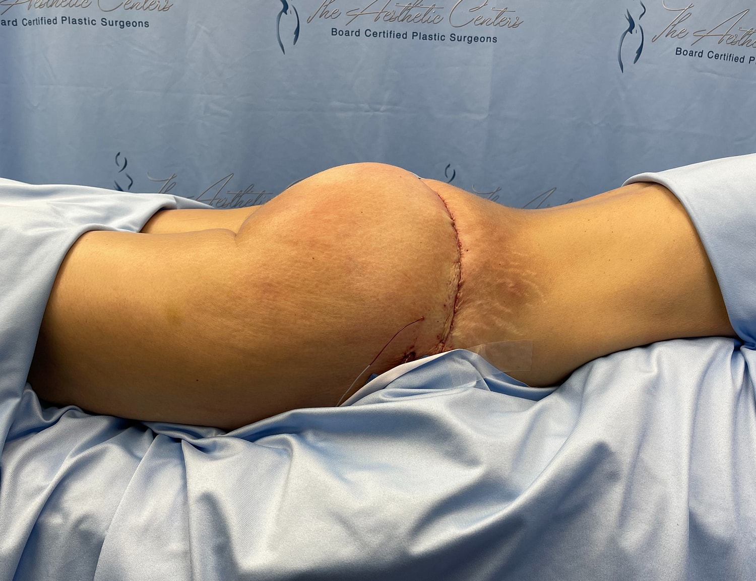 Patient post-surgery with visible incision site.