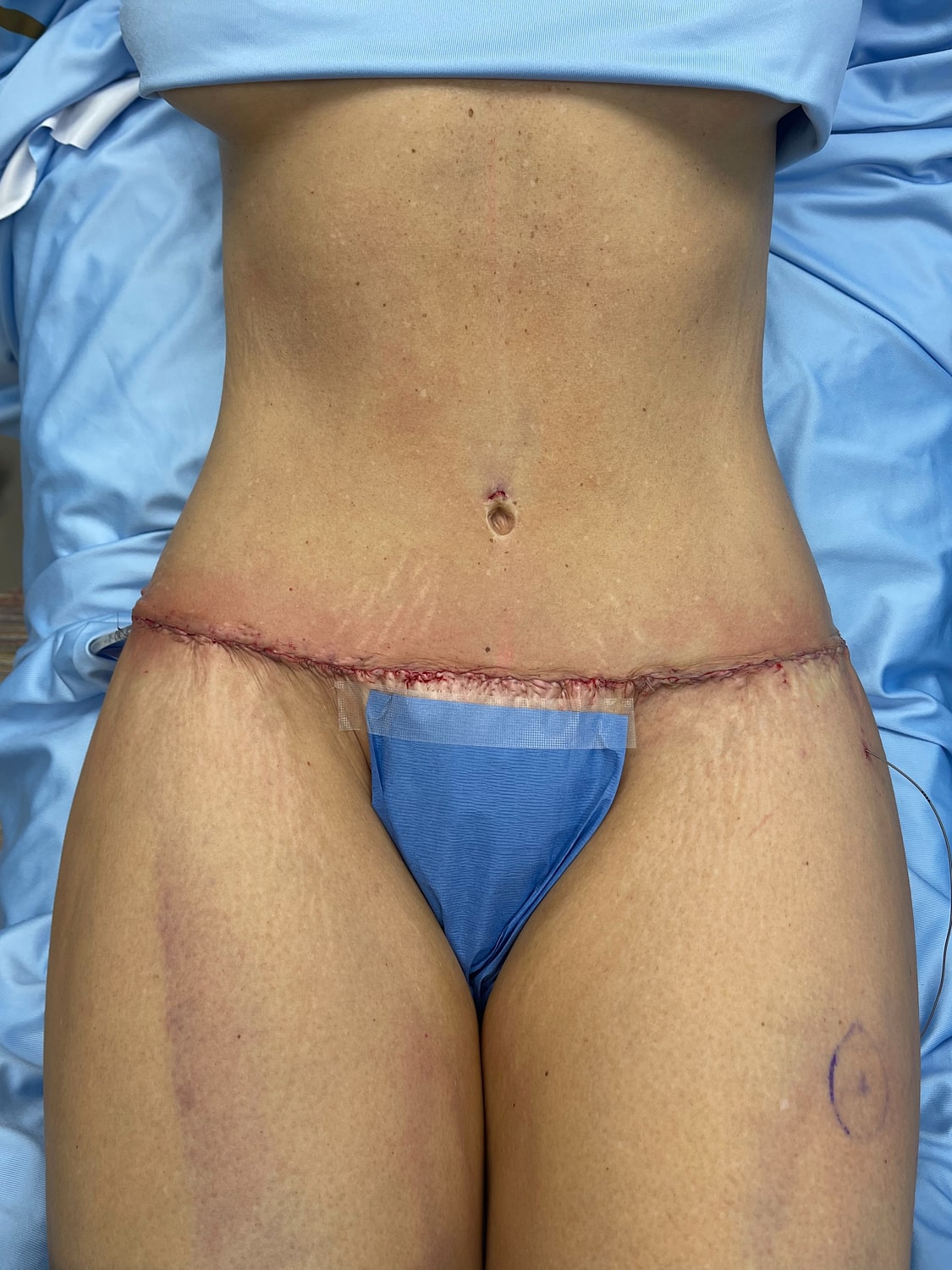 Post-surgery abdominal area with stitches visible.