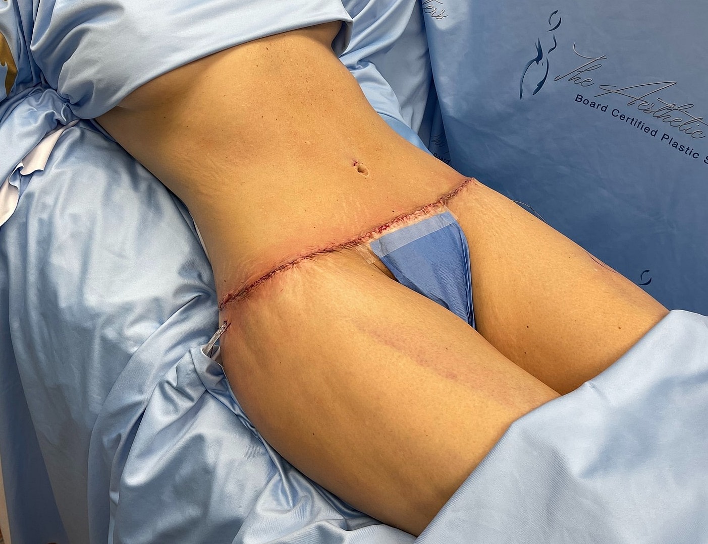 Post-surgery abdomen with stitches and dressings.