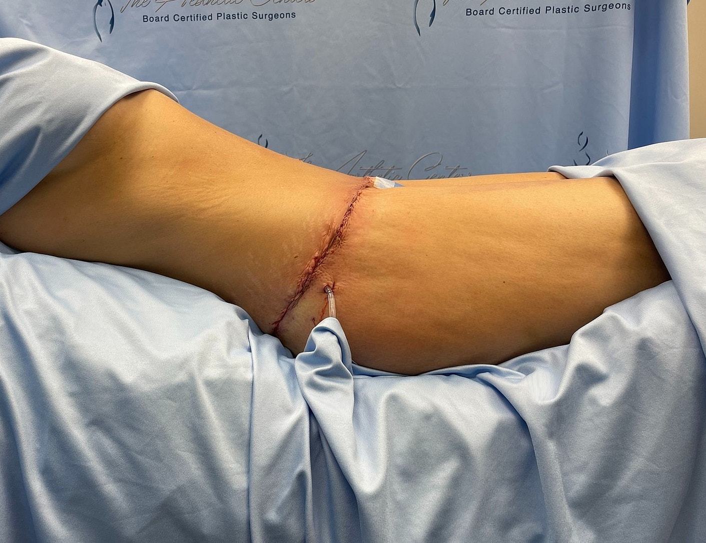 Post-surgery incision on a patient's abdomen.