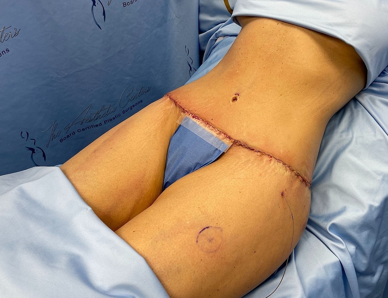 Post-surgery abdomen with incision line visible.