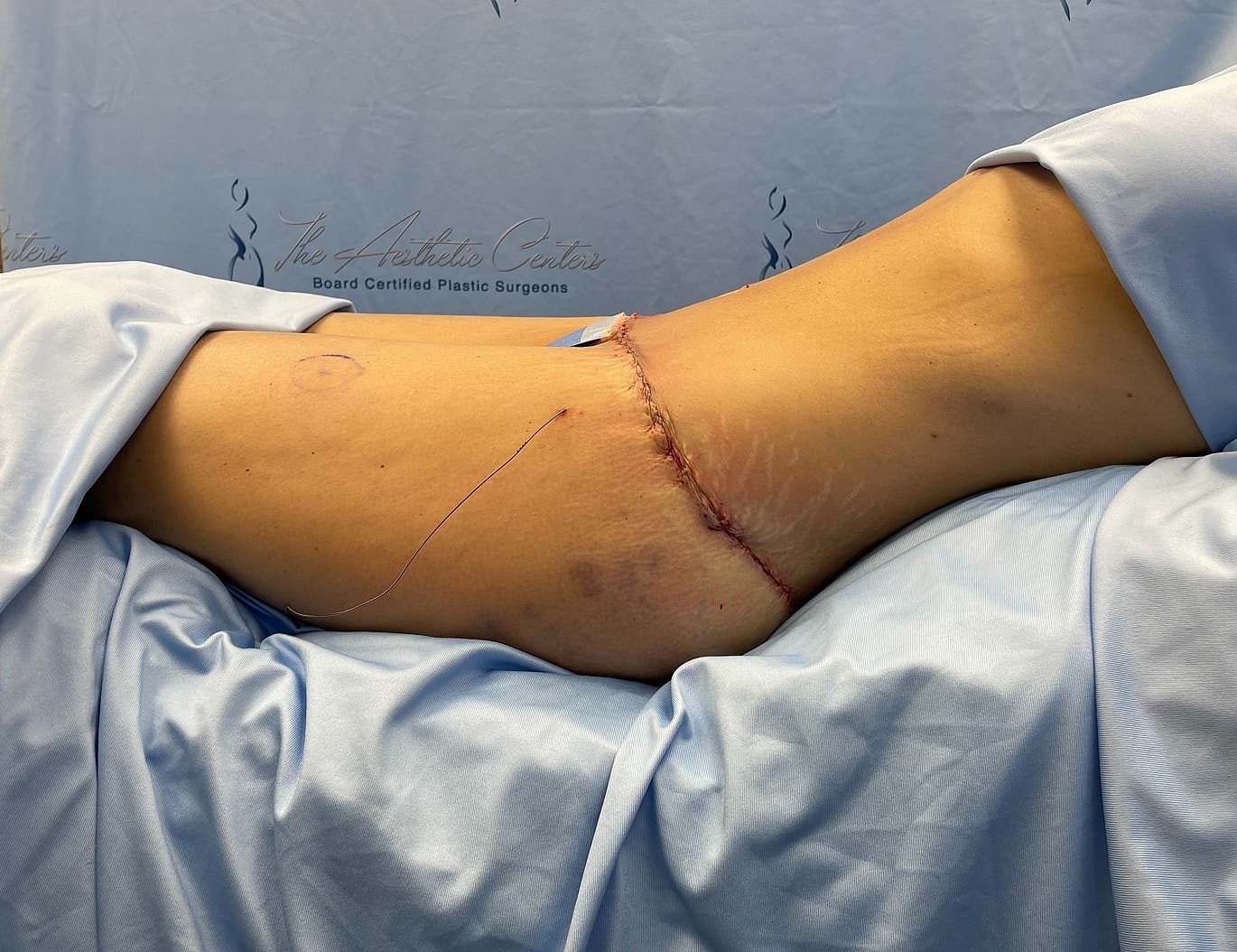 Post-surgery recovery with visible incision on torso.
