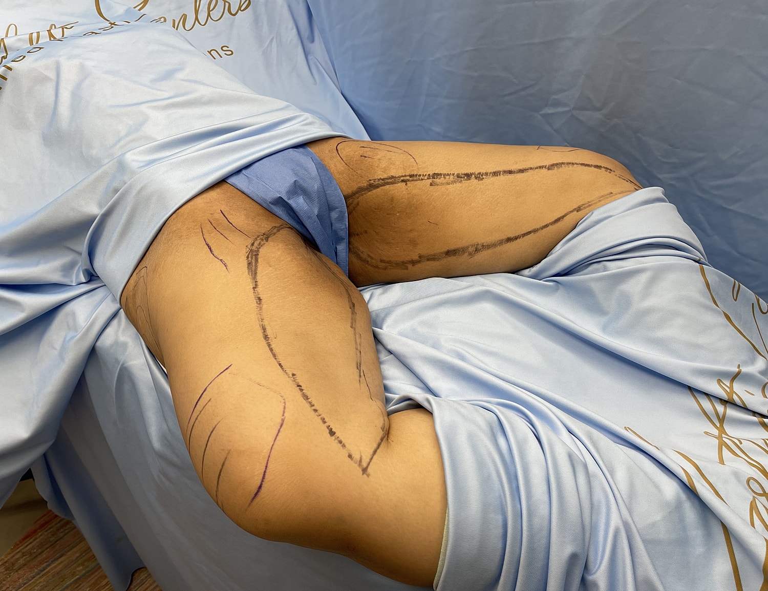Marked arm preparing for a medical procedure.