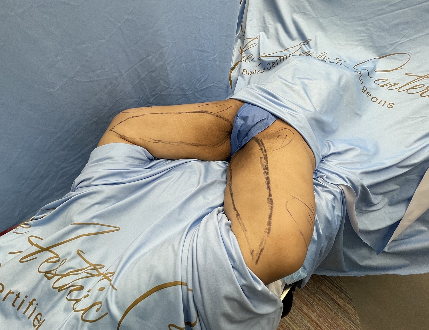 Patient with marked areas for cosmetic procedure.