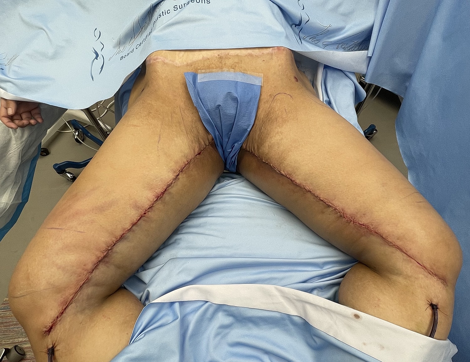 Surgical recovery with visible incision marks.