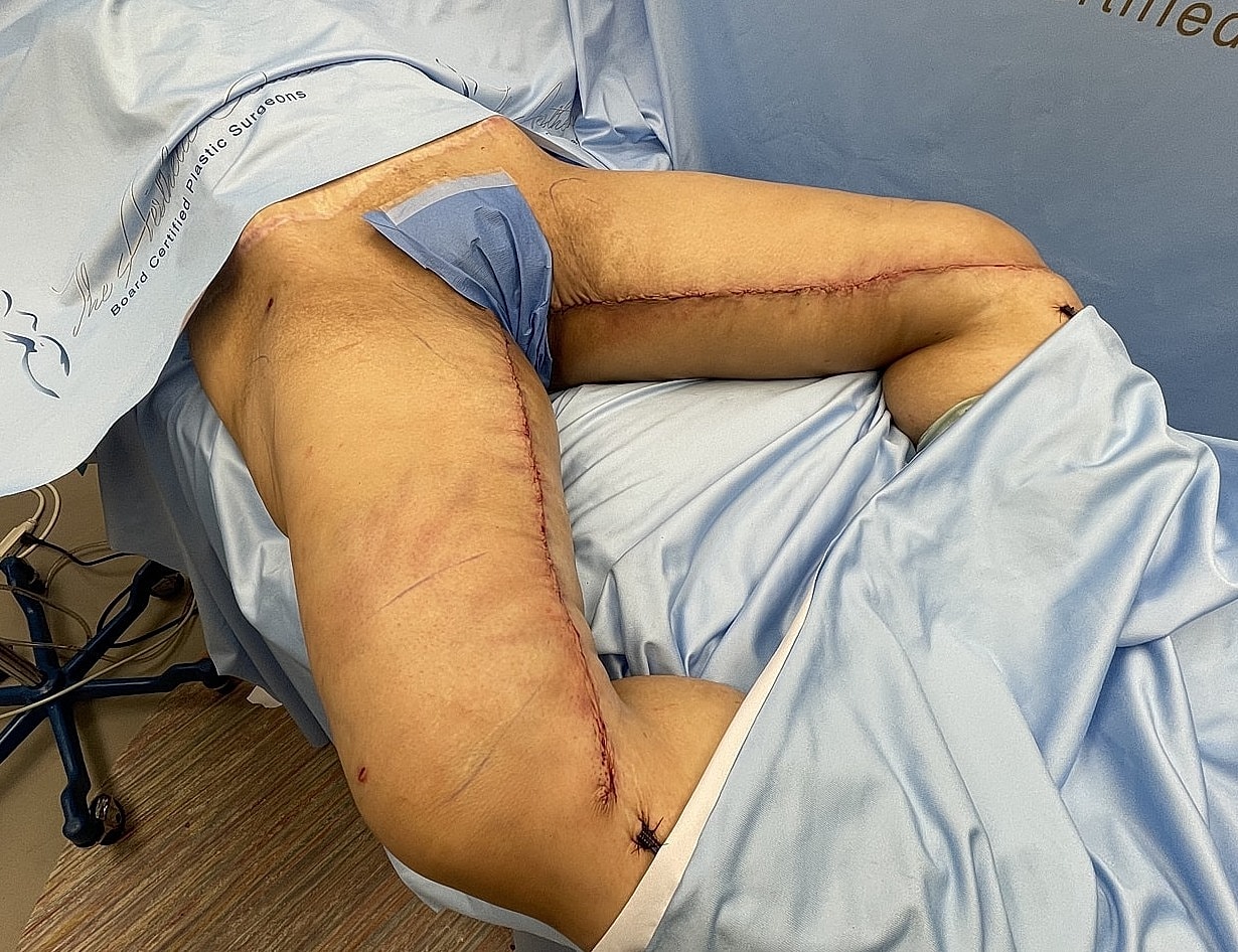 Post-surgical recovery with visible incisions on leg.
