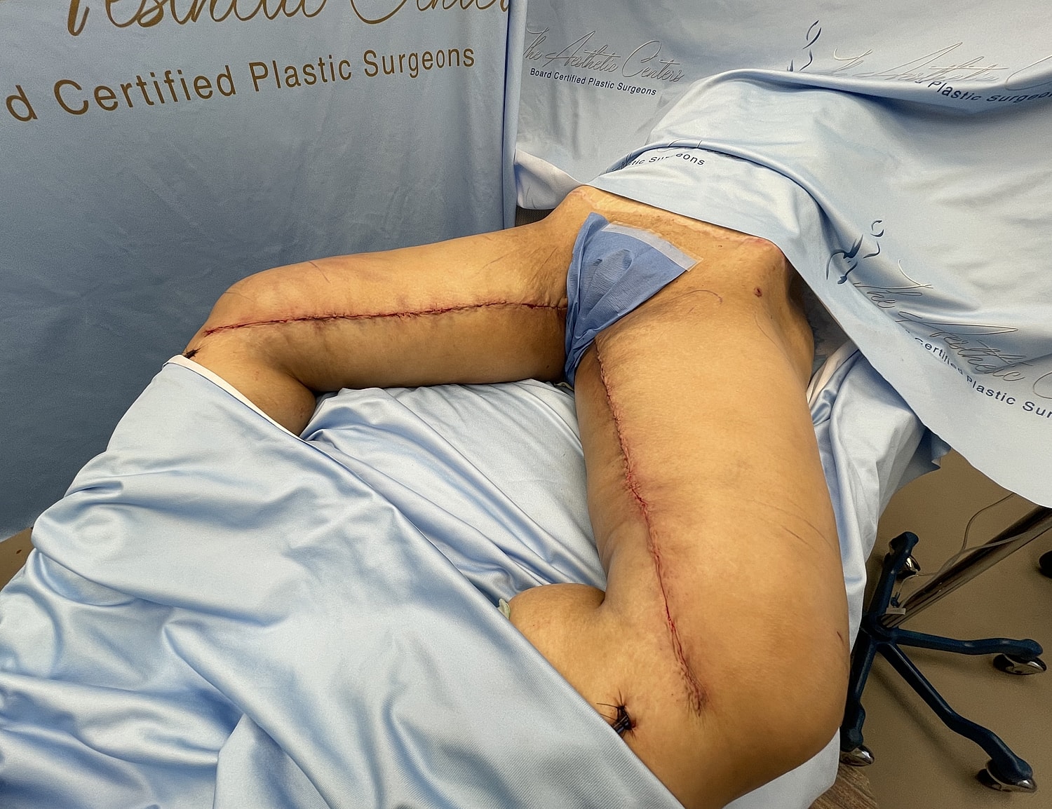 Surgical scars on a patient's leg.