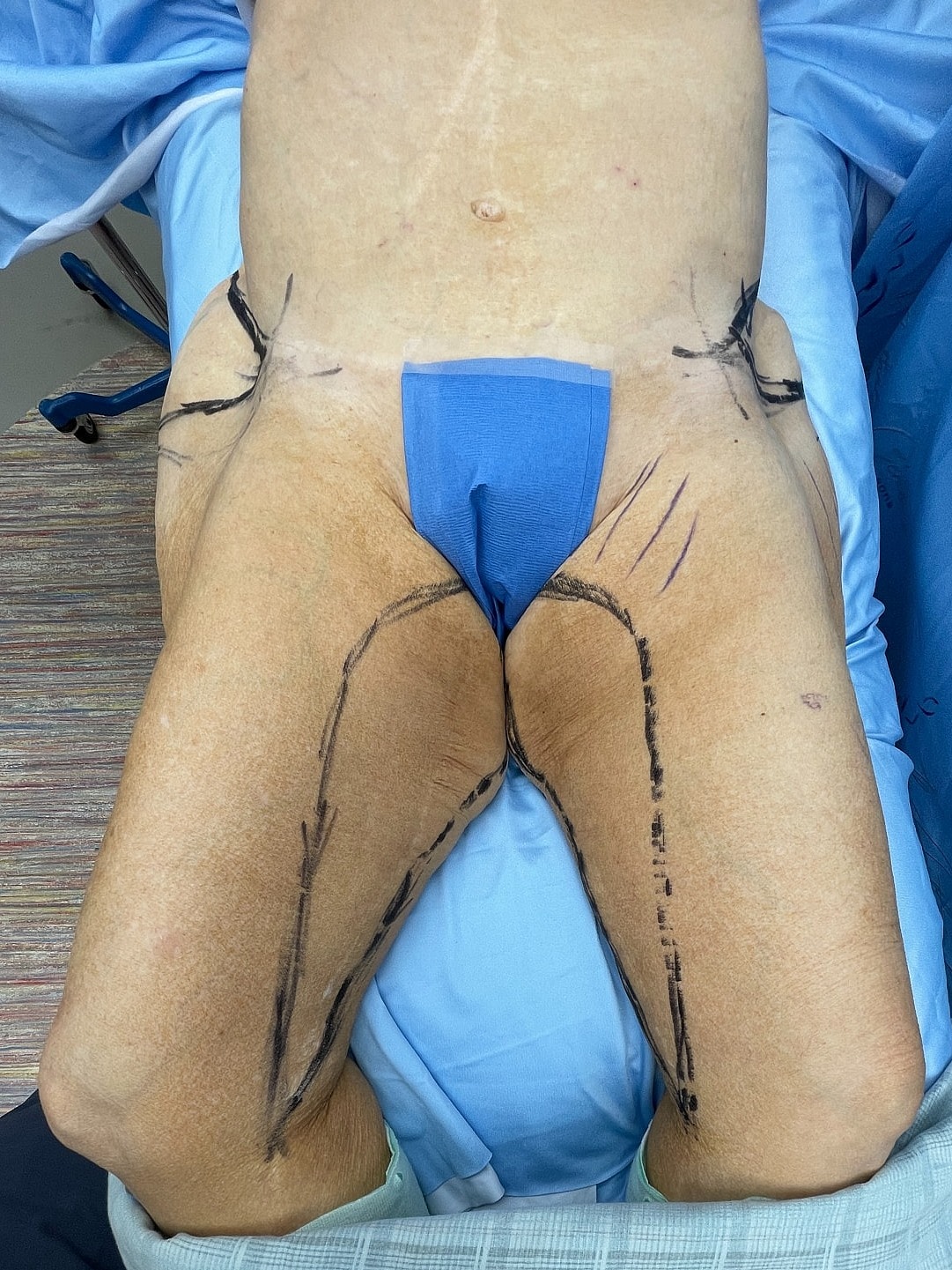 Pre-surgery patient with marked areas on thighs.