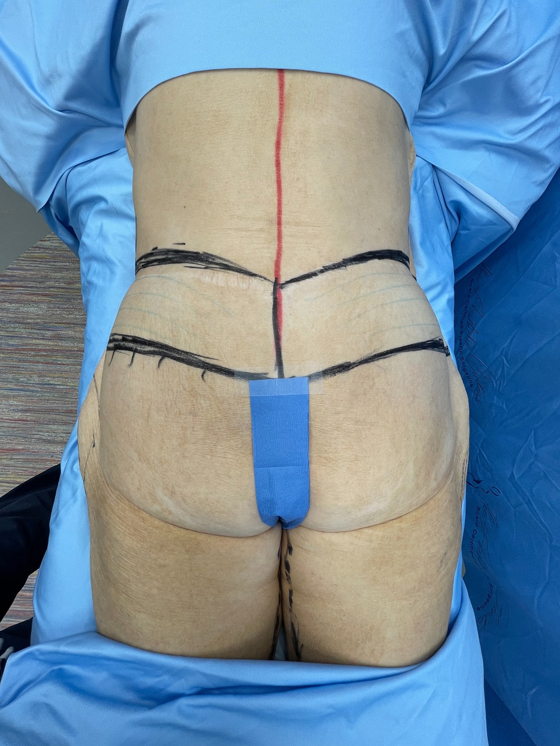 Surgical markings on a patient's back for procedure.