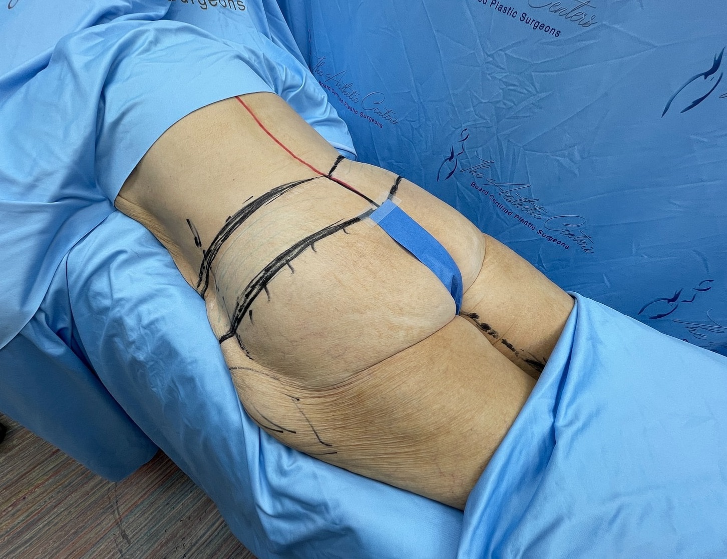 Surgical preparation for body contouring procedure.