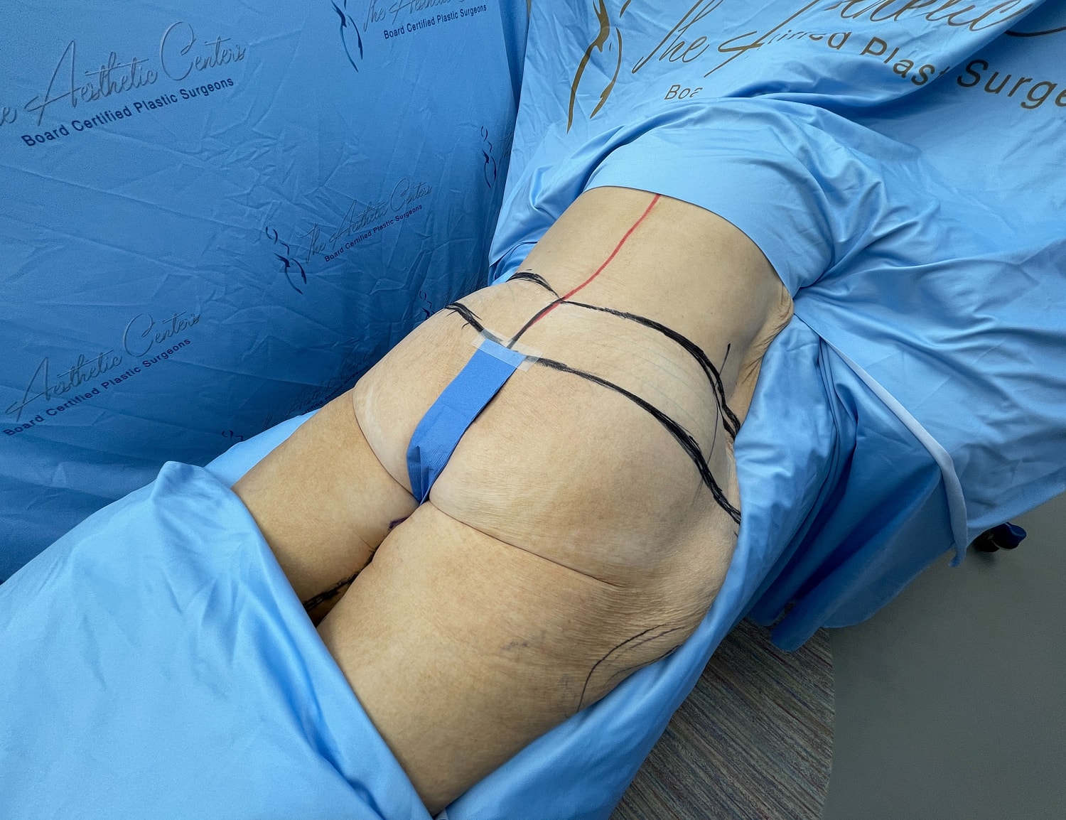 Surgical markings on patient’s body before procedure.
