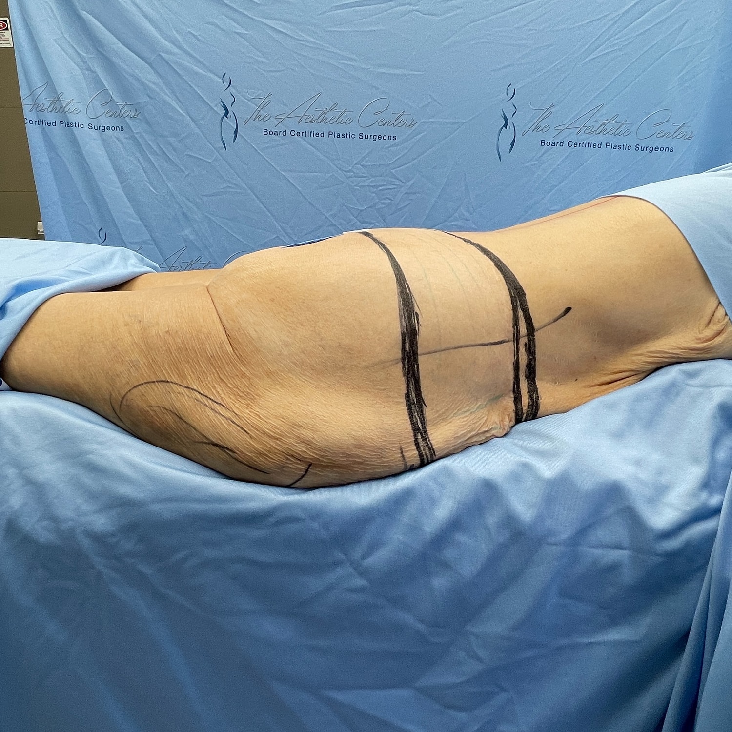 Patient preparation for a surgical procedure.