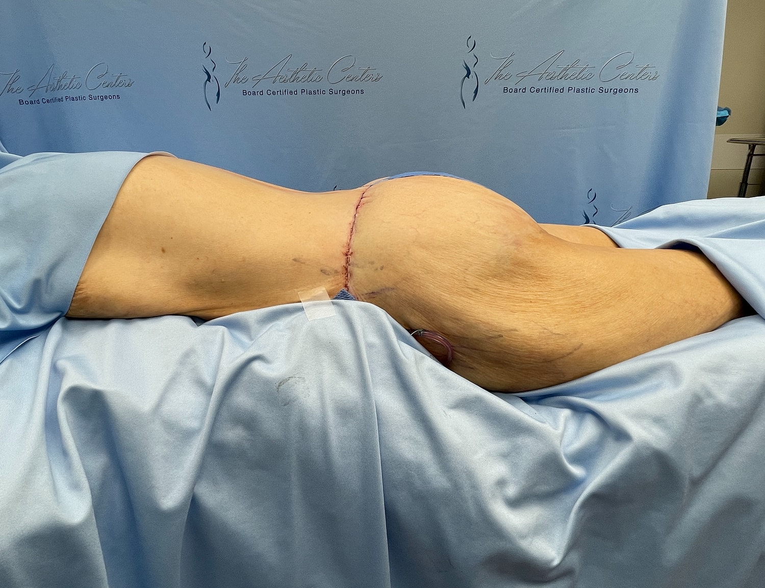 Post-surgery patient lying on examination table.