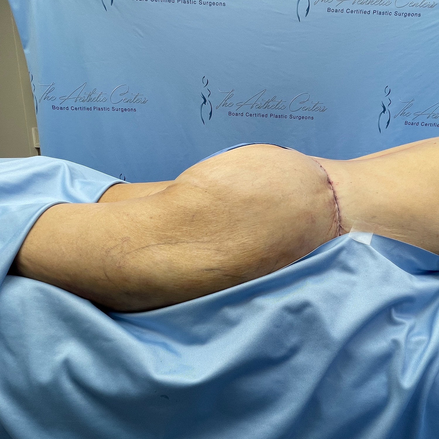 Post-surgery view of hip area with stitches.
