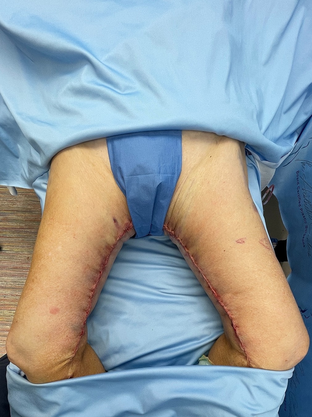 Post-surgery legs with visible incision marks.