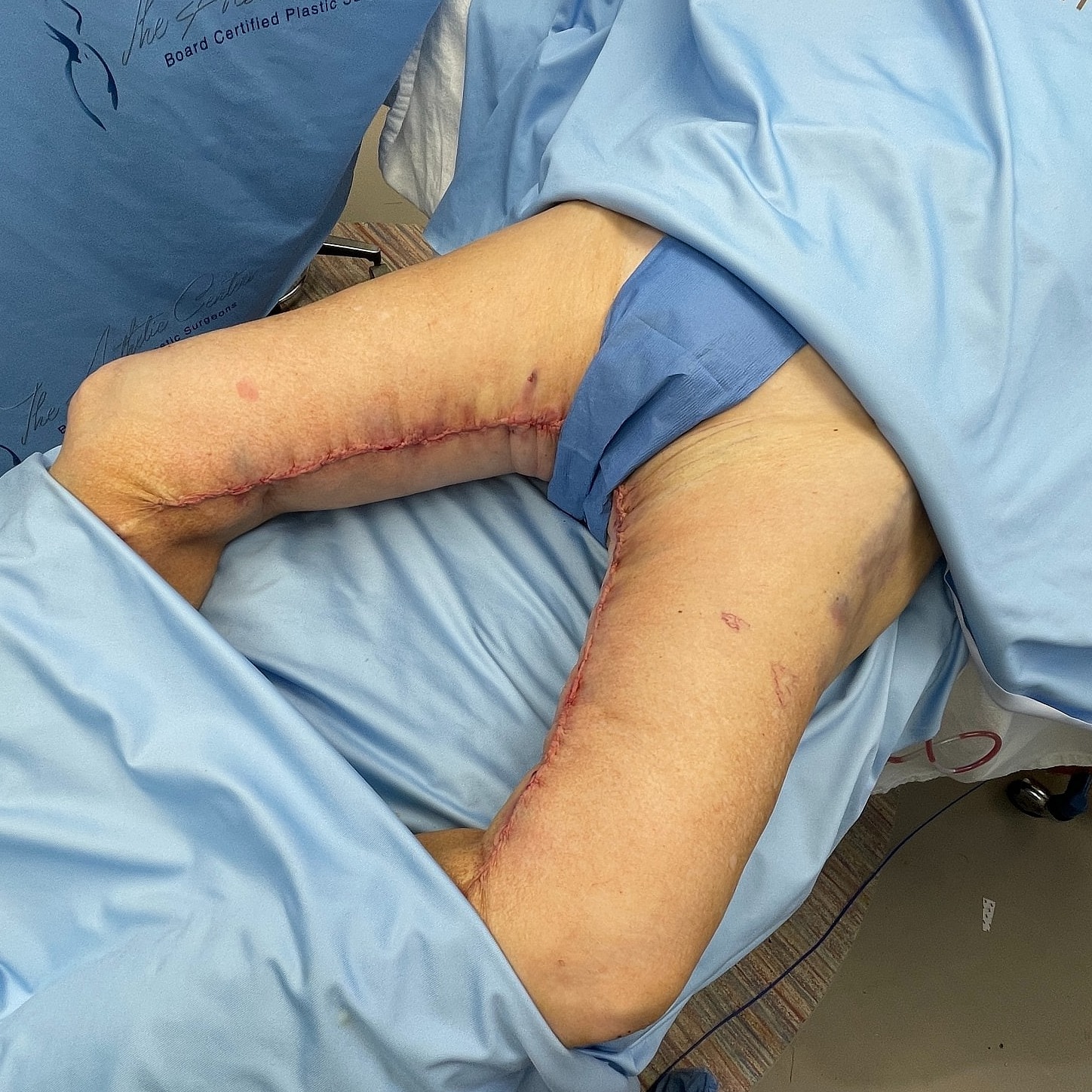 Post-surgery leg with stitched incision visible.
